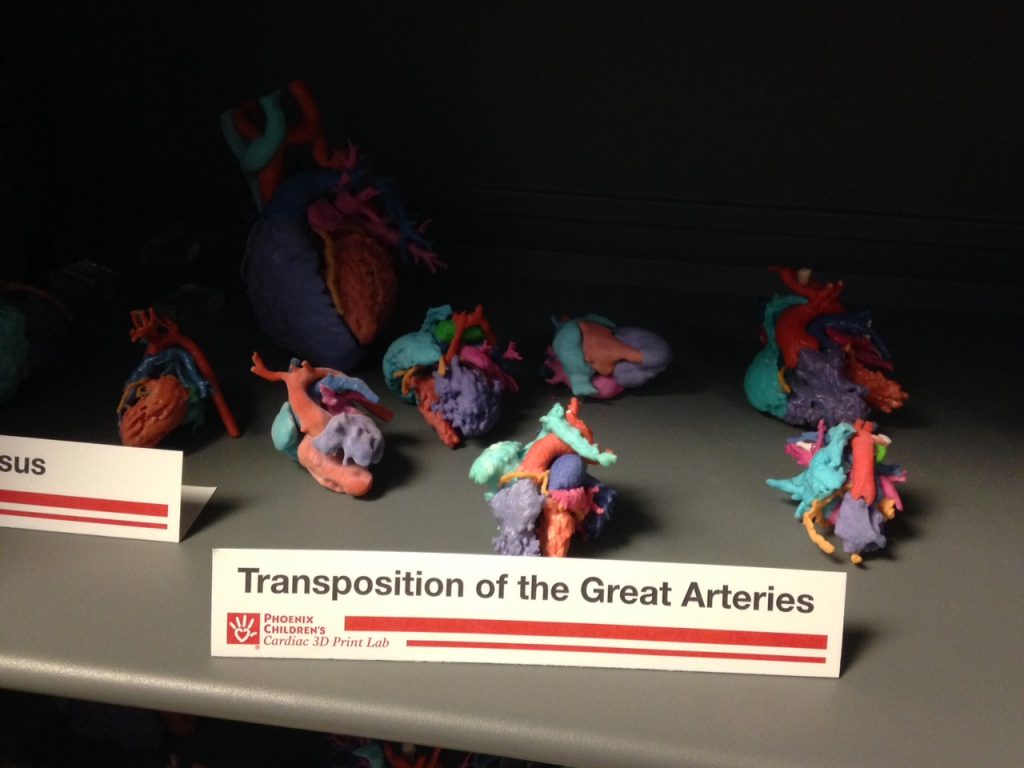 Some of the hundreds of 3D-printed pediatric heart models produced at the Phoenix Children’s Hospital Cardiac 3D Print Lab. Each model displays a unique defect in need of surgical correction. Note the adult-size heart in the left rear for size comparison.  (Image courtesy Phoenix Children’s Hospital)