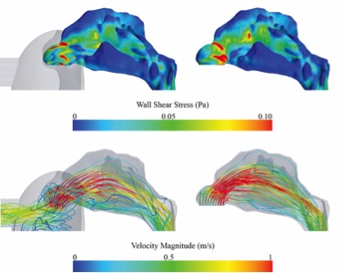 Wall Shear Stress distributions at the nasal cavity’s wall (upper panel) and velocity information visualized using streamlines (lower panel). Those distributions are shown for simulations using a simplified mask (left) as well as for simulations, where the nasal cavity was truncated at the nostrils.